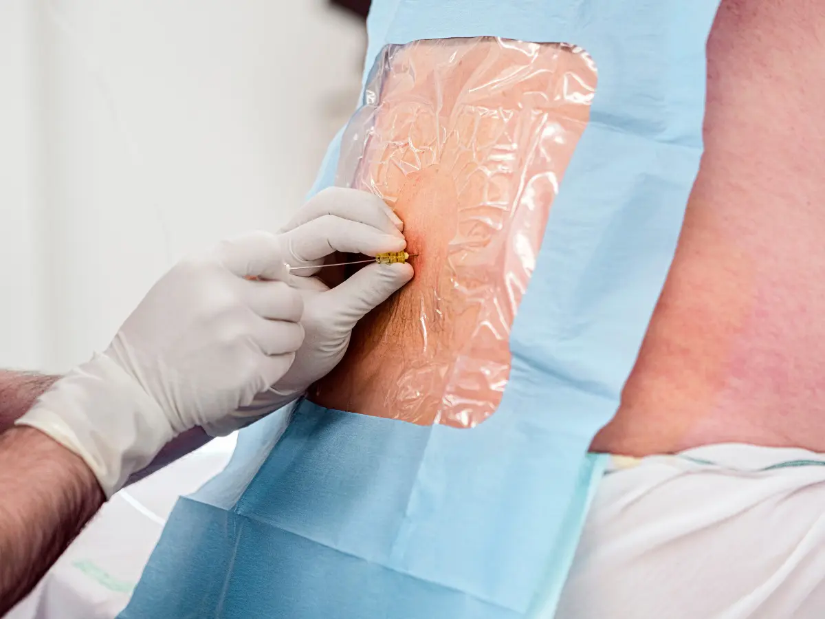 A patient prepped and draped for an epidural. Gloved hands are getting ready to perform the procedure.