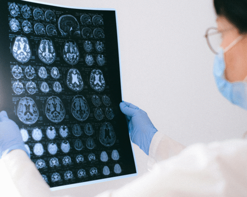 Medical professional reviewing brain MRI scans related to neurological injury, seizures, or potential brain damage associated with kratom use and product liability claims.