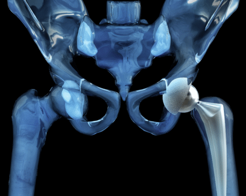 3D medical illustration of a human pelvis with a hip replacement implant, highlighting a prosthetic joint used in orthopedic surgery and potential device-related complications.