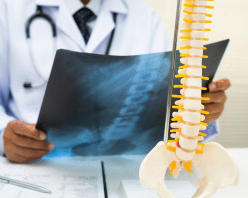 Doctor reviews a spinal X-ray beside a spine model, representing the diagnosis of spinal infections such as spinal epidural abscess, vertebral osteomyelitis, and discitis, highlighting delayed diagnosis, neurological complications, and potential medical malpractice related to missed spinal infections.