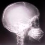 An X-ray of a human skull