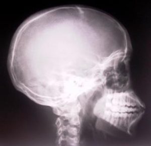 An X-ray of a human skull