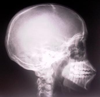 An X-ray of a human skull