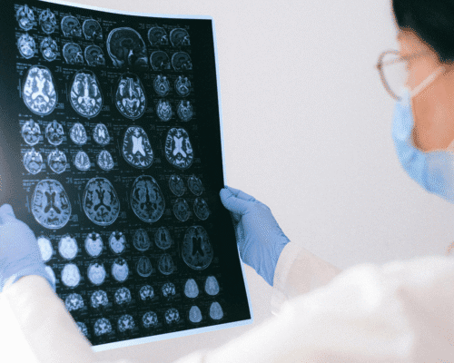 Medical professional reviewing brain MRI scans related to neurological injury, seizures, or potential brain damage associated with kratom use and product liability claims.